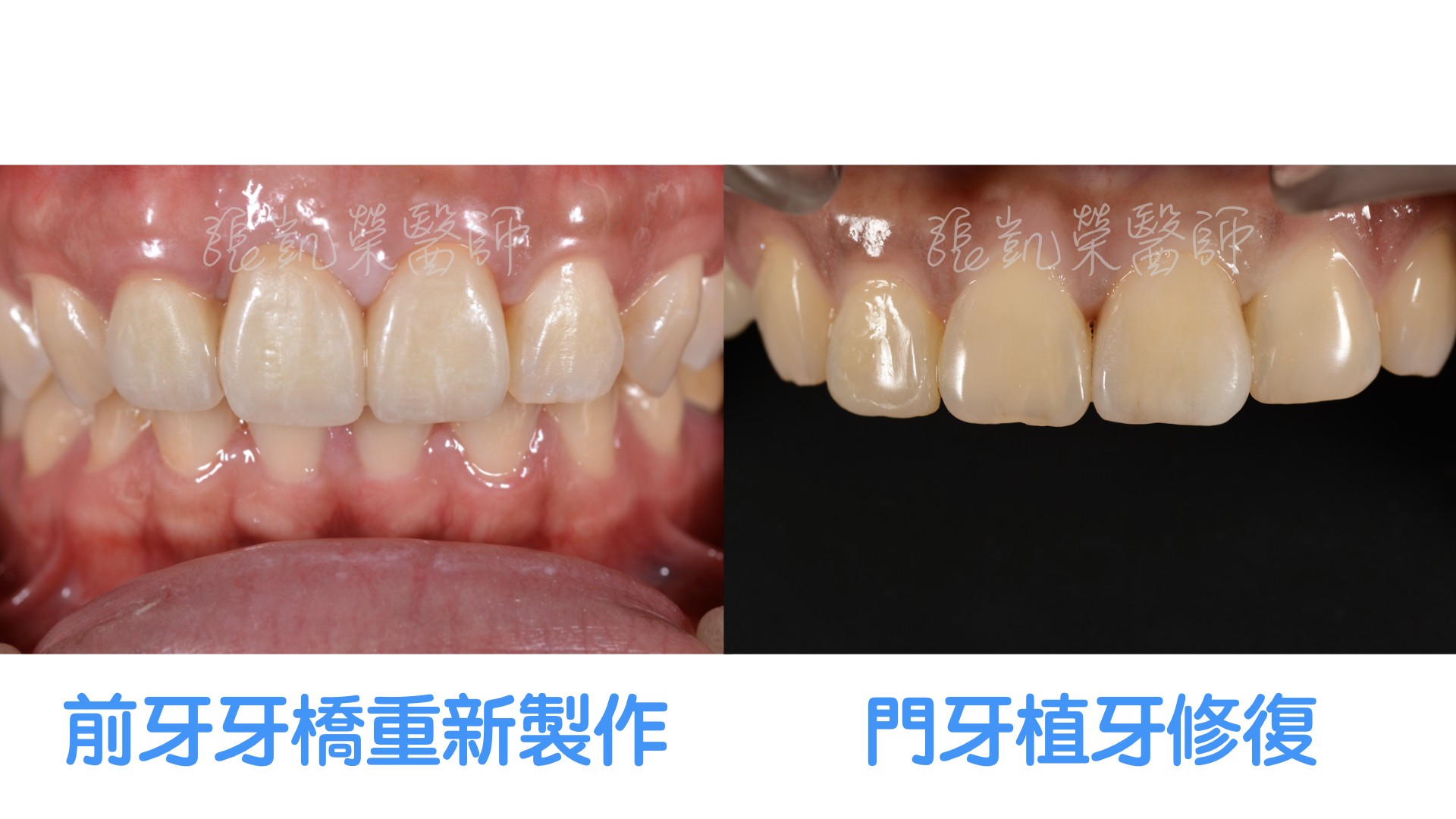 假牙不密貼該怎麼處理？part II:牙齒組織損傷太嚴重，無法修復